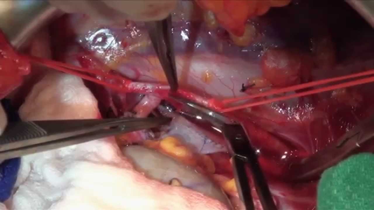 kidney surgery in bilaspur
